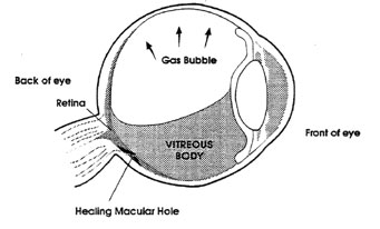 Vitrectomy